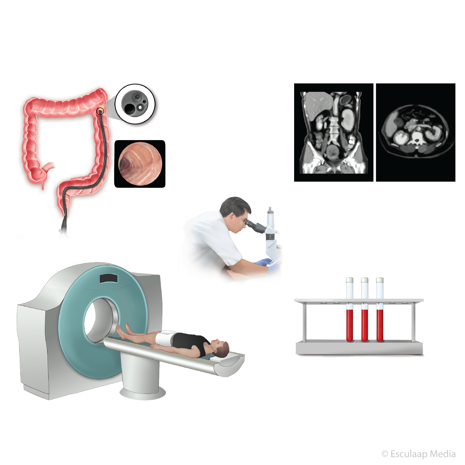Diagnostiek Van Dikkedarmkanker