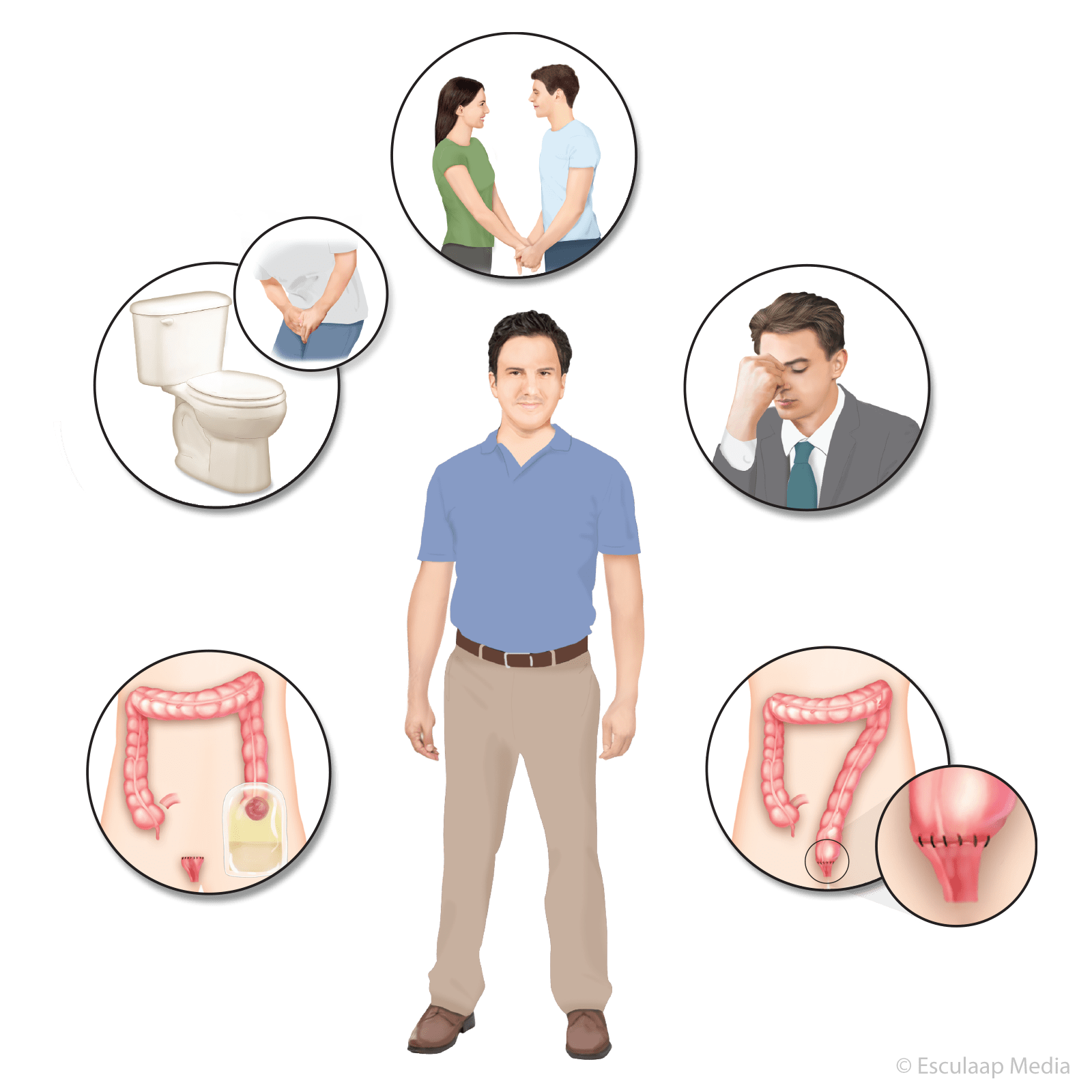 Gevolgen Van Behandeling Bij Darmkanker