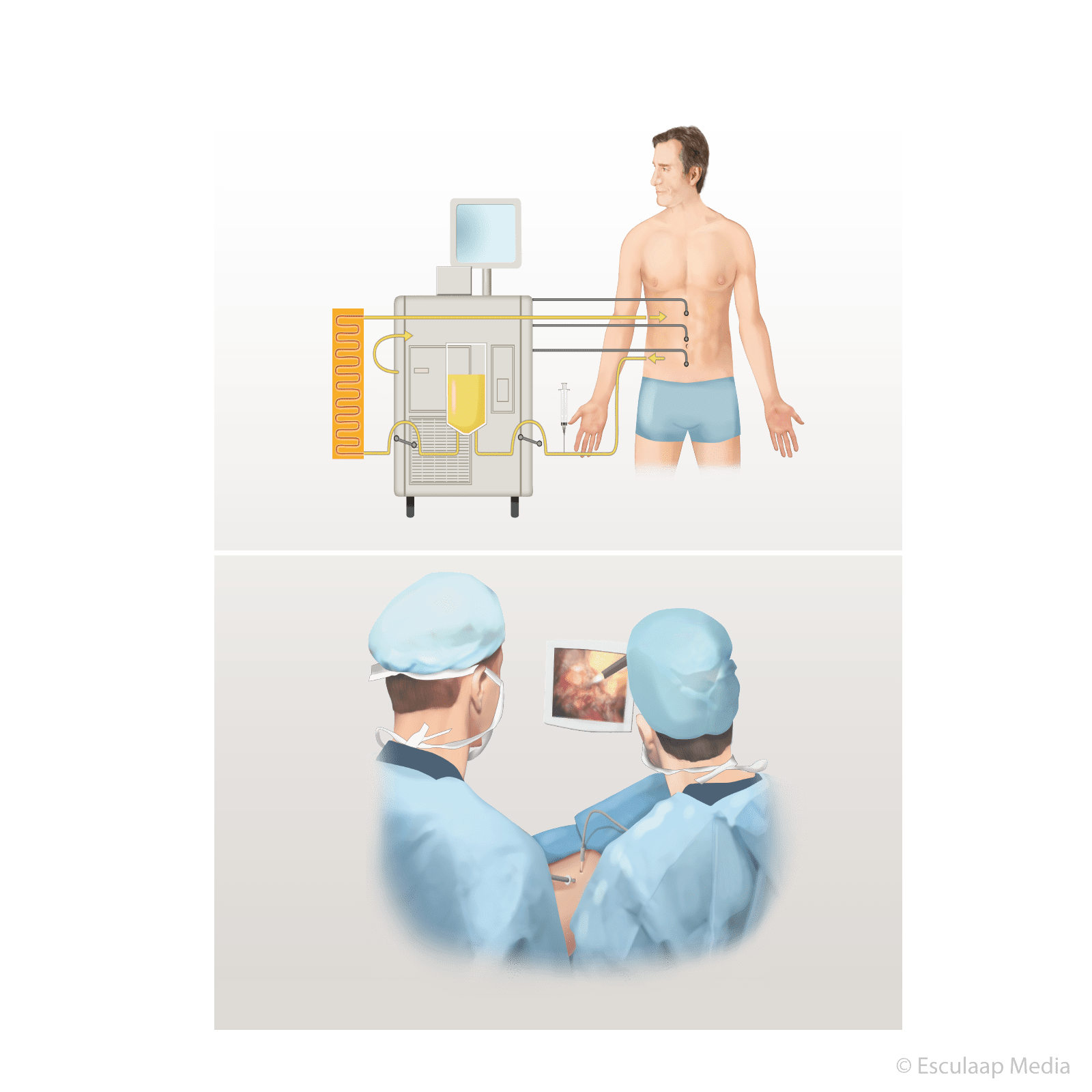 Operatie Van Metastasen